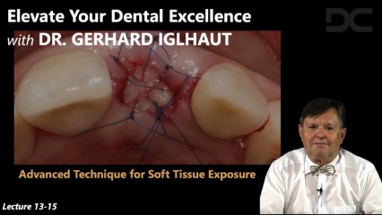 Advanced technique for soft tissue exposure 